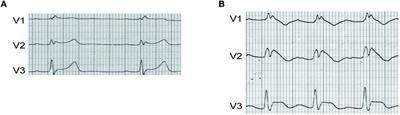 “Pill-in-the-Pocket” Treatment of Propafenone Unmasks ECG Brugada Pattern in an Atrial Fibrillation Patient With a Common SCN5A R1193Q Polymorphism